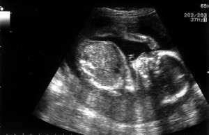 alat deteksi janin antara ilmu kedokteran dan syariat